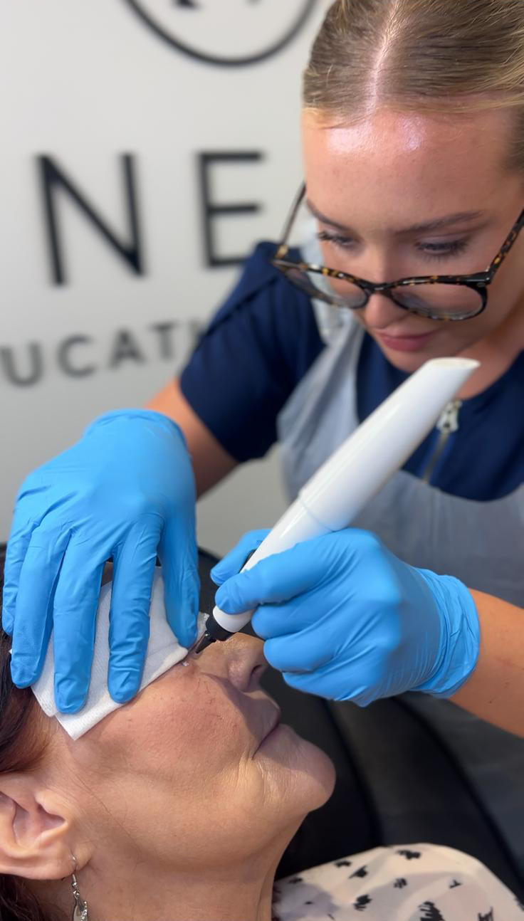 CyroPen Skin Tag Removal