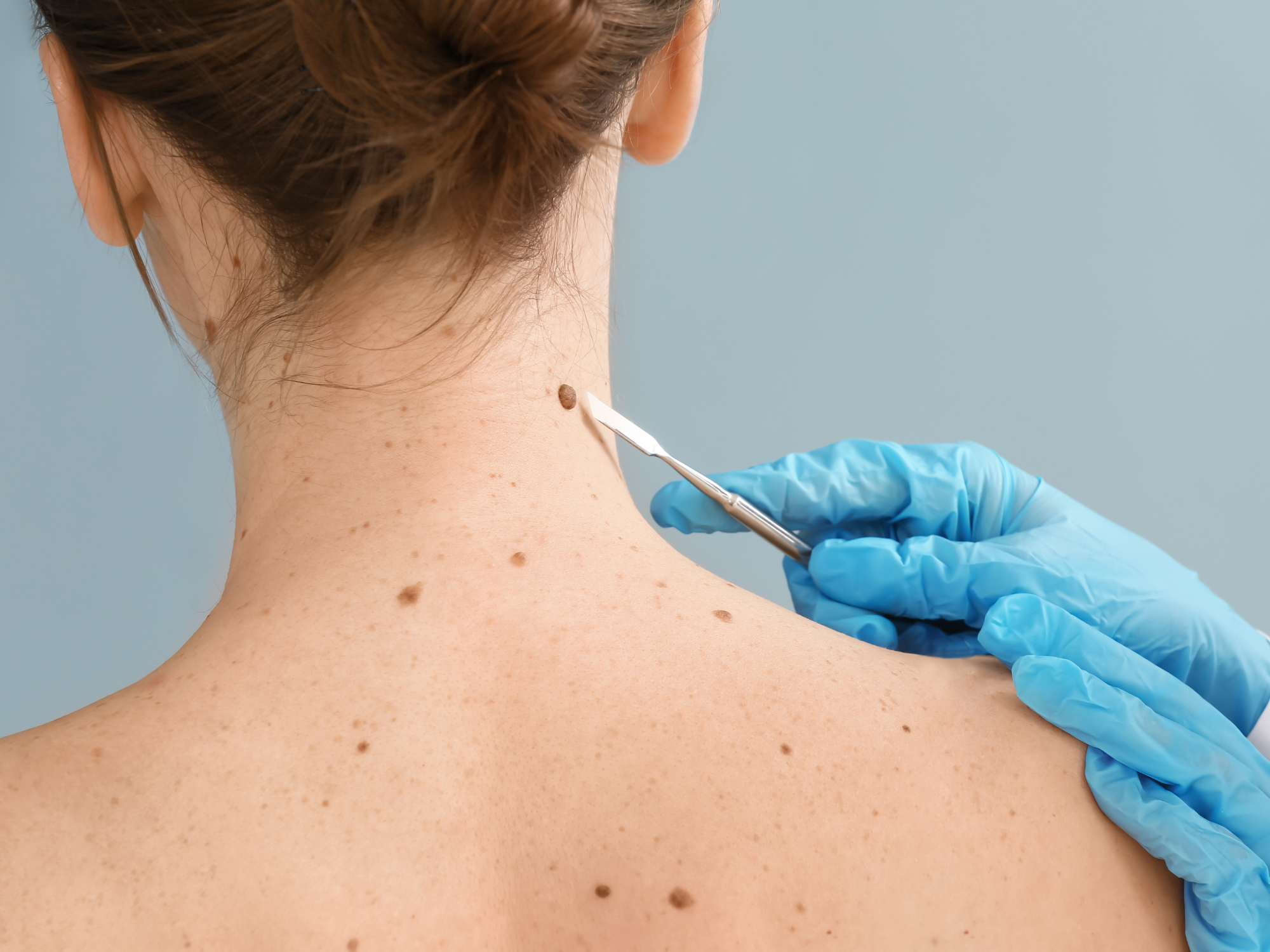 Skin Tags