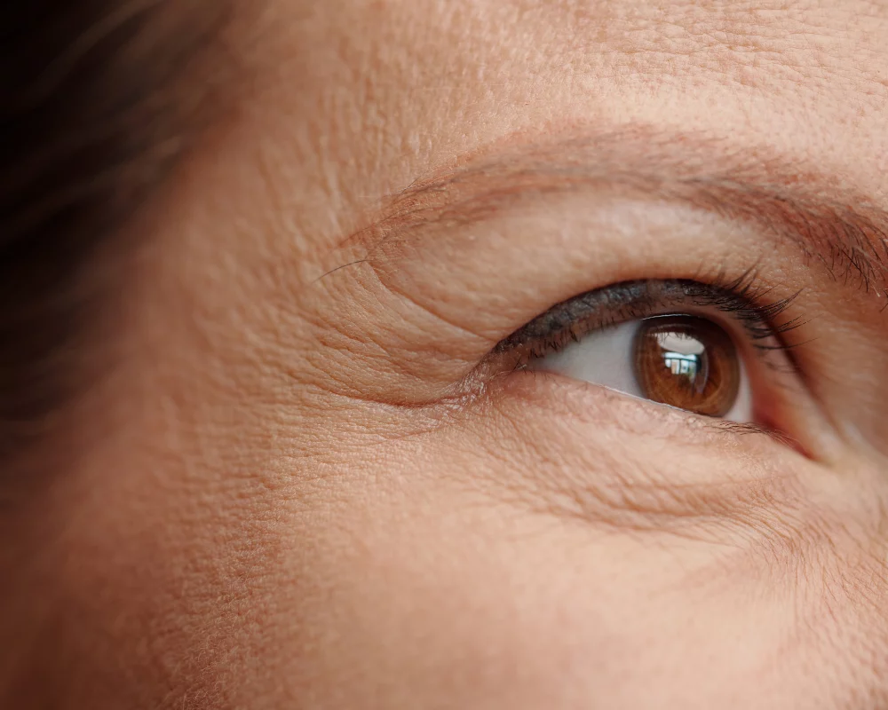 Botox Wrinkle Injections