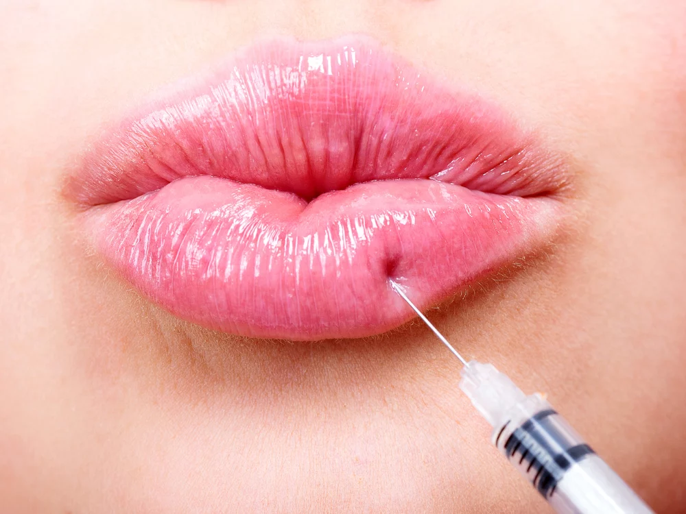 Lip Dermal Fillers Lip Fillers