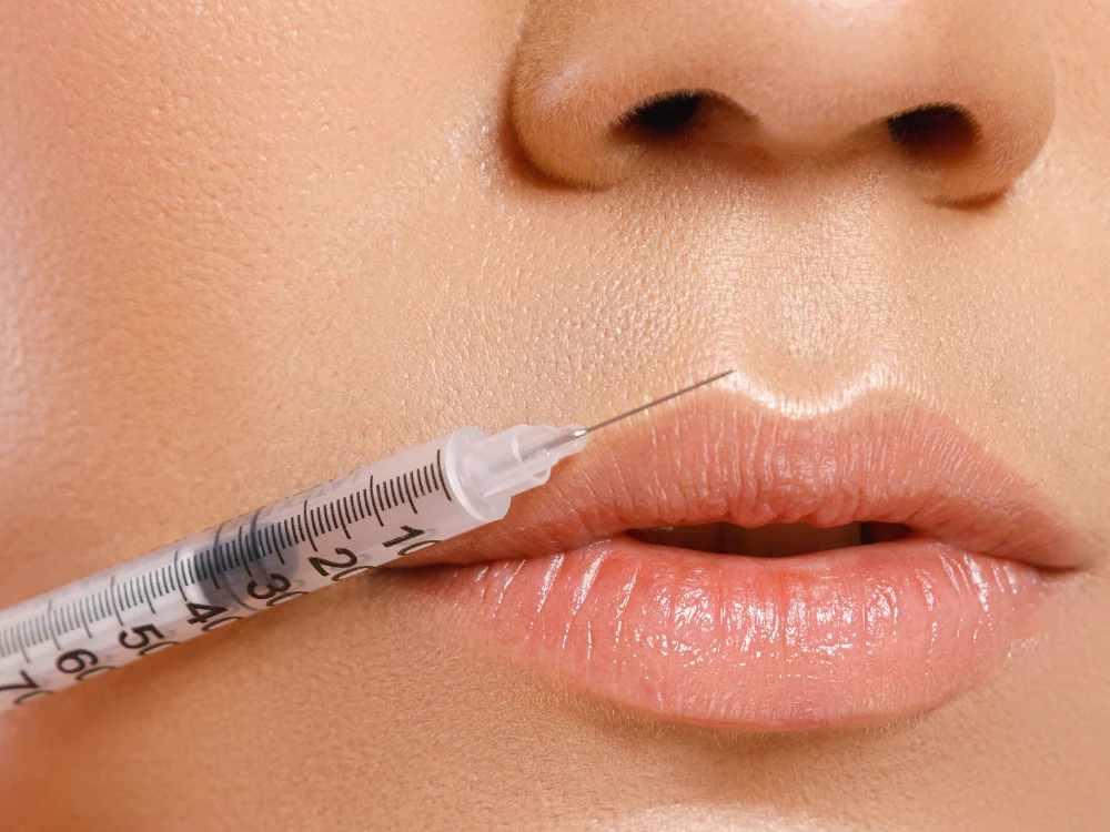 Lip Fillers