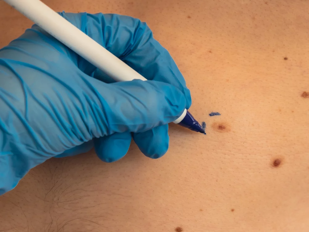 Skin Lesion Removal