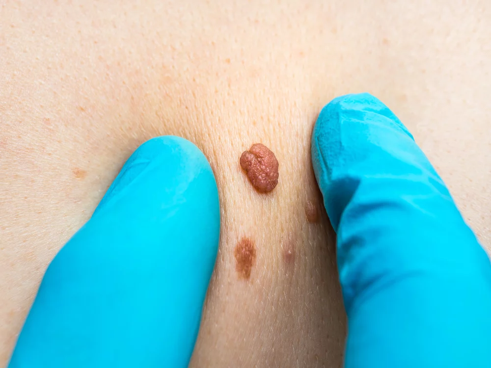 Skin Lesion